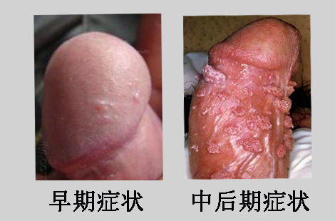 男人龟头生花柳图片