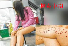 梅毒到底是什么病