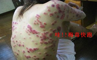 红色的嘎达是梅毒吗