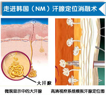 韩国NM汗腺定位消融术.jpg